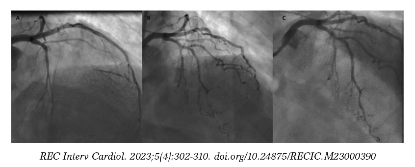 Angioplastia Con Bal N Farmacoactivo Para Oclusi N Cr Nica Bifurcada