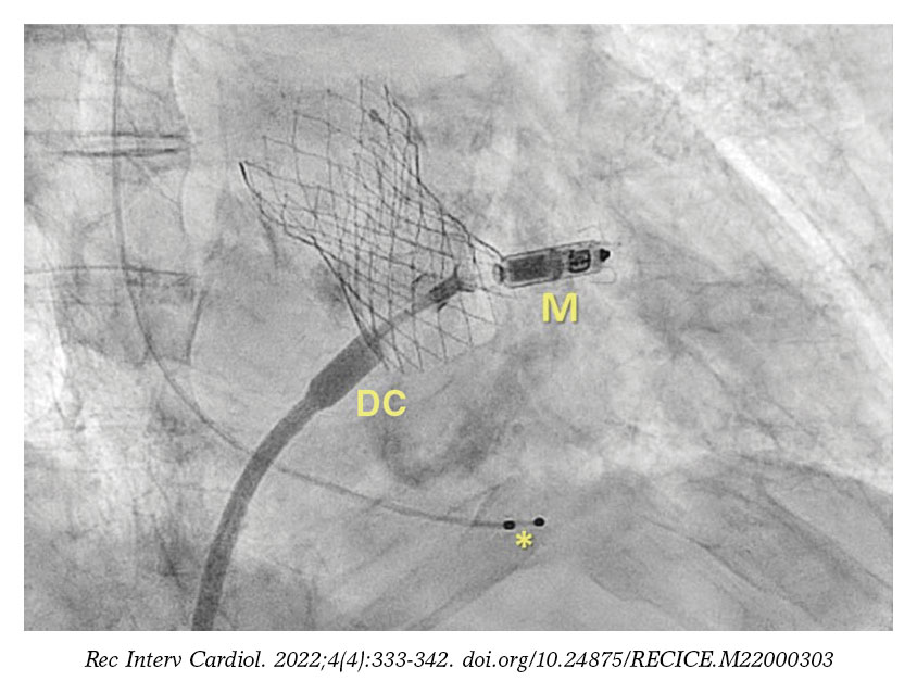 Micra leadless pacemaker and transcatheter aortic valve implantation at