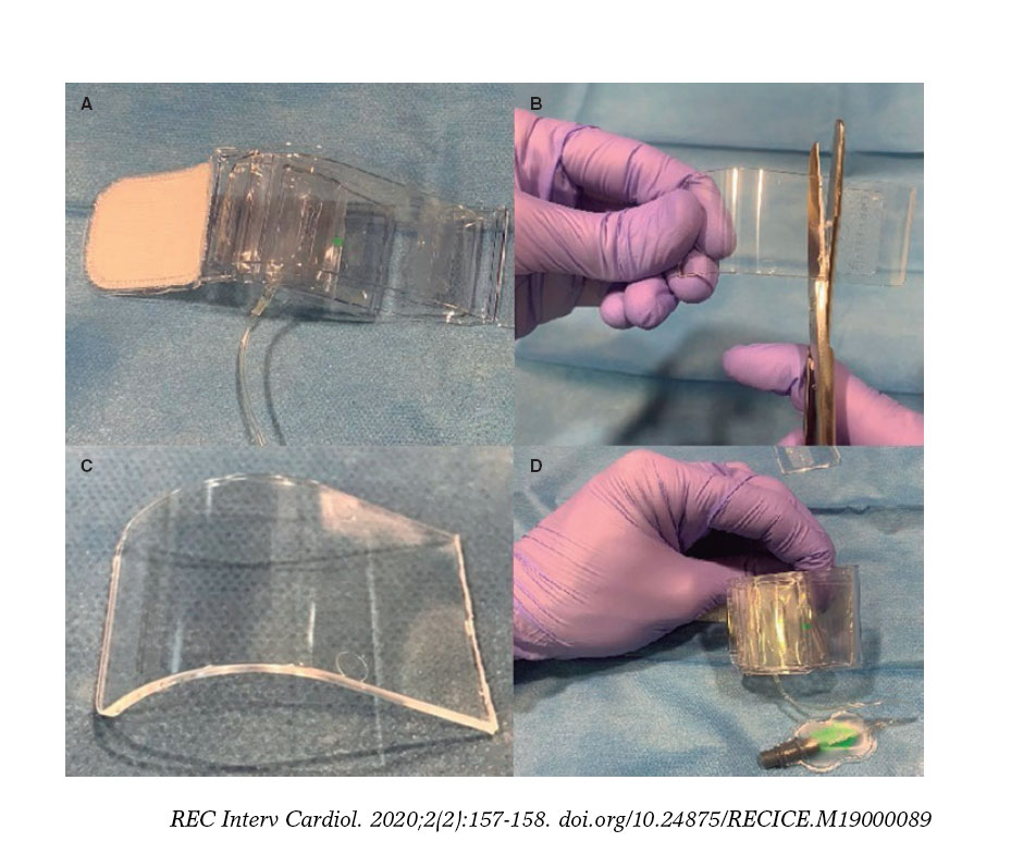 Tr Band Modification For Distal Transradial Access Hemostasis Letters