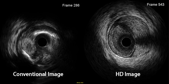 High Definition Intravascular Ultrasound Innovation In Interventional Cardiology