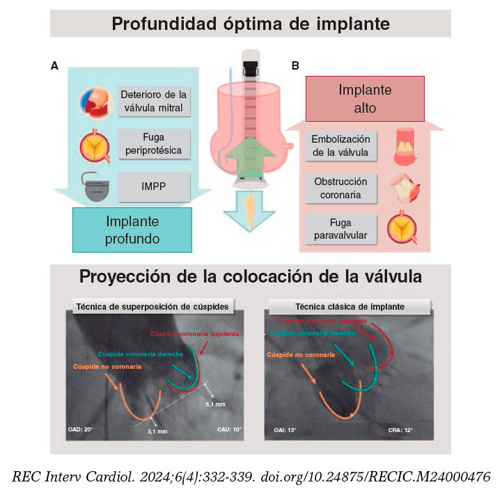 El papel de la proyección del implante para optimizar el implante