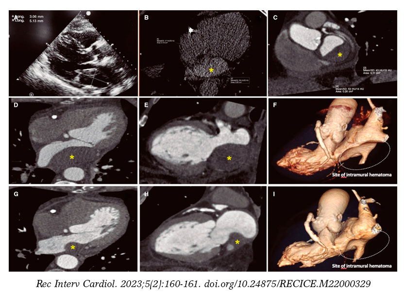 Atrial mass as a complication following complex percutaneous coronary ...