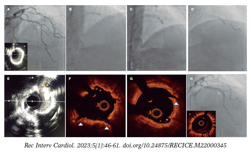 What is Calcified Plaque? - RAI