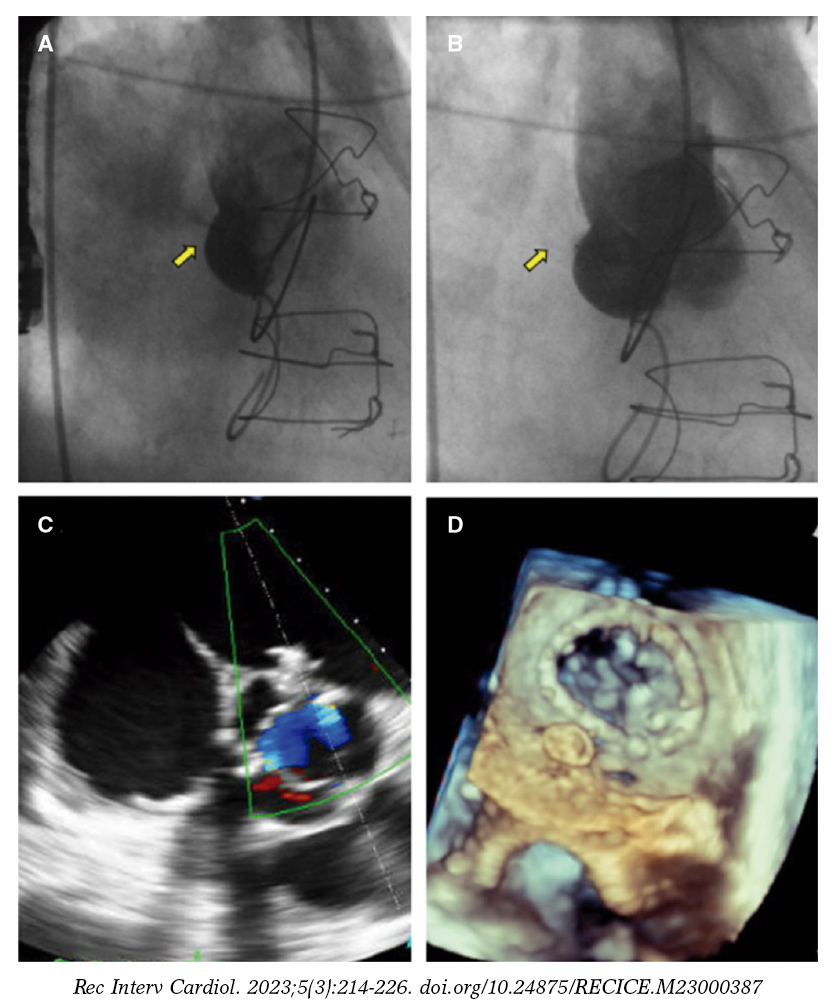 https://recintervcardiol.org/images/cardiology/uk/RECIC_23_022_UK-F2.jpg