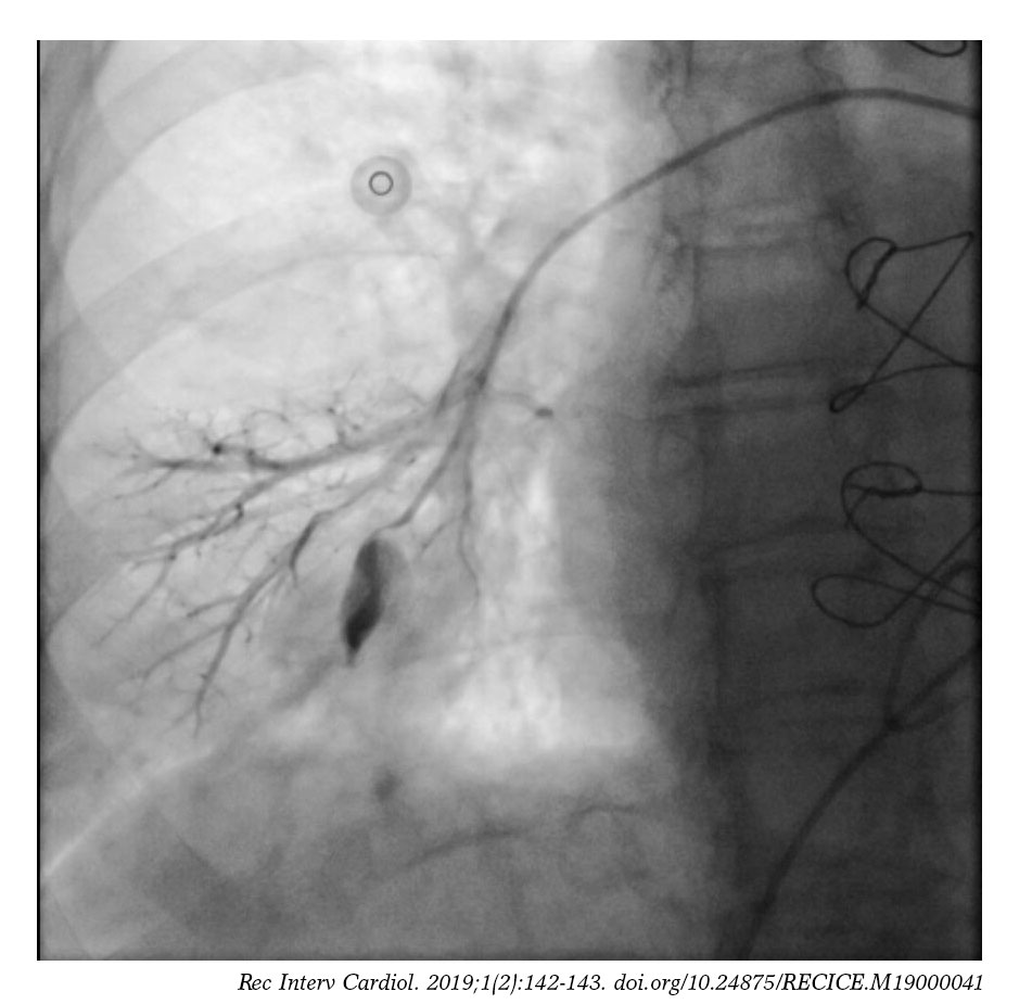 Pulmonary artery pseudoaneurysm as a SwanGanz catheter complication