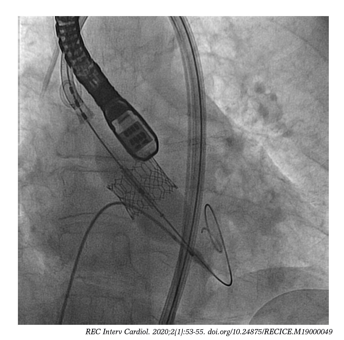 Simultaneous transfemoral TAVI and angioplasty of unprotected