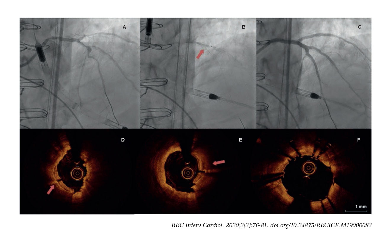 Intracoronary lithotripsy in a highrisk realworld population. First