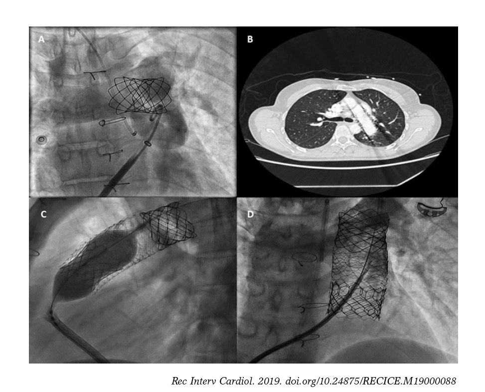 Percutaneous reconstruction of pulmonary trunk to solve stent embolization