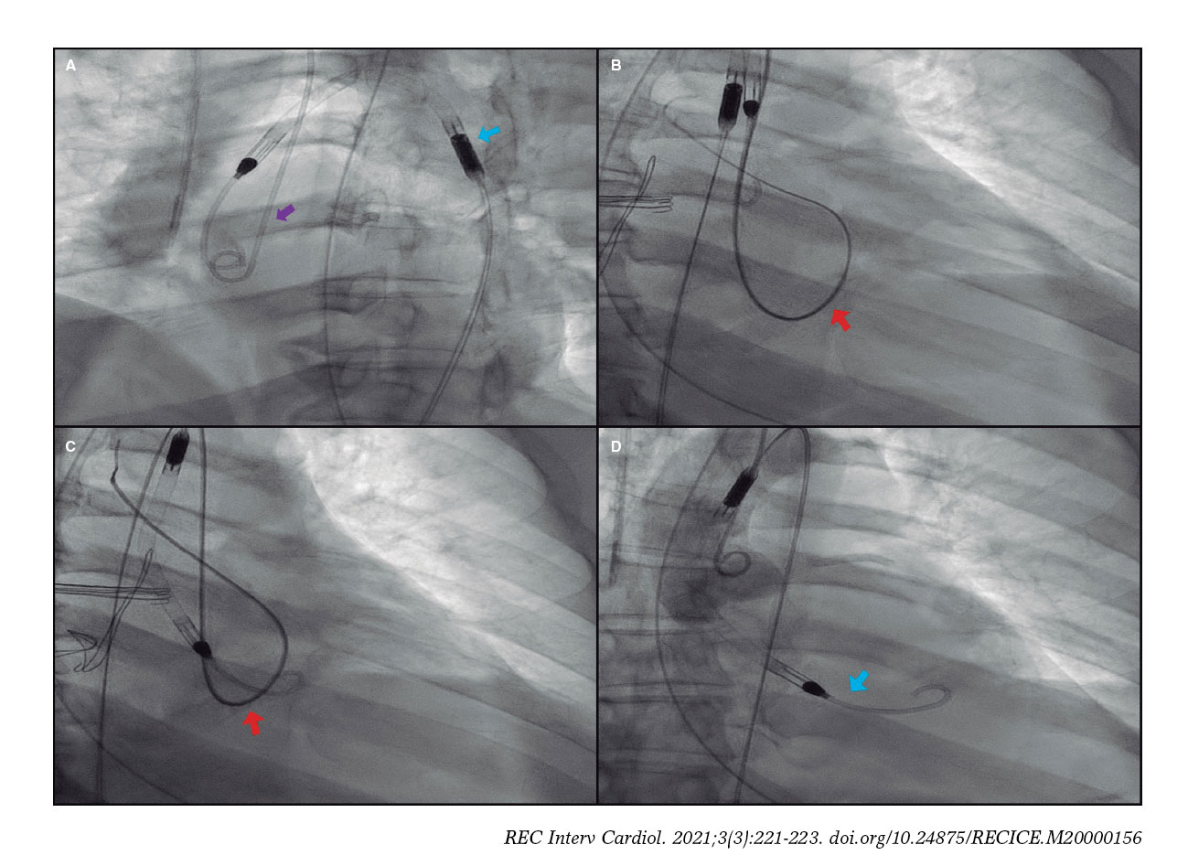 New technique for the emergent repositioning of the displaced Impella ...