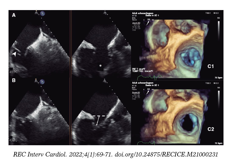 Percutaneous edge-to-edge tricuspid valve repair in congenitally ...