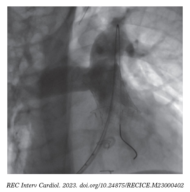 The PULSTA valve in native right ventricular outflow tract initial