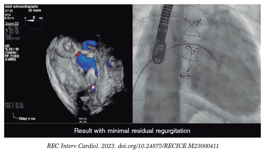 Closure Of A Percutaneous Tricuspid Paravalvular Leak With The 