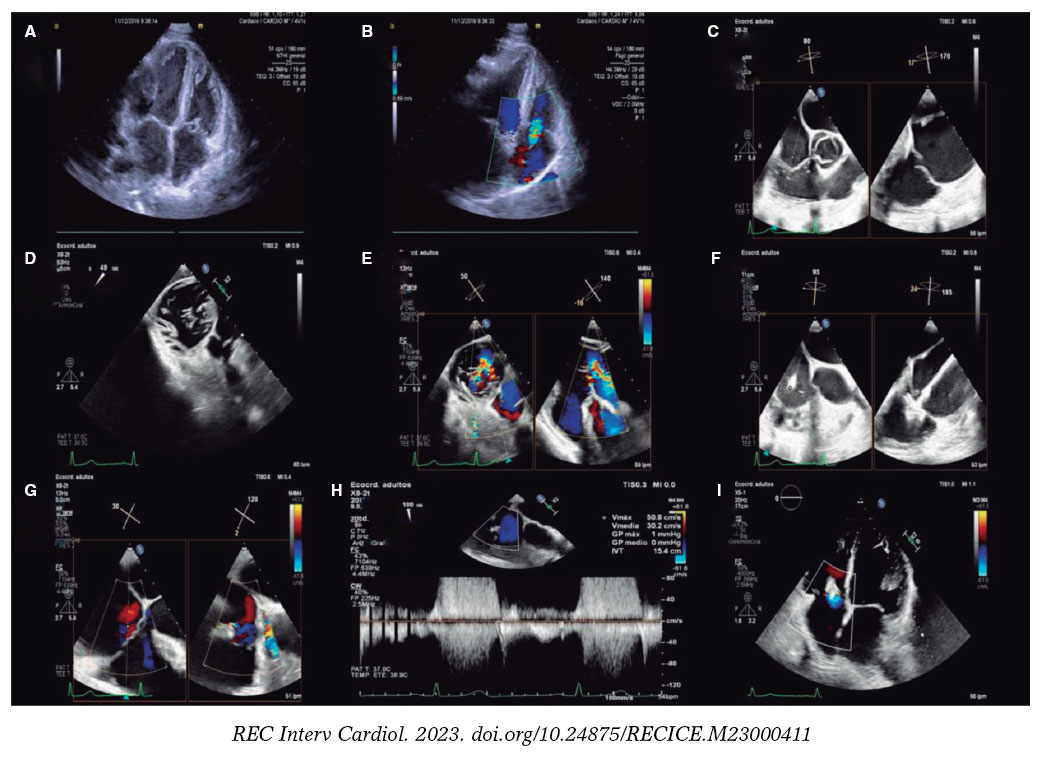 Severe postransplant tricuspid regurgitation: treatment with the PASCAL ...