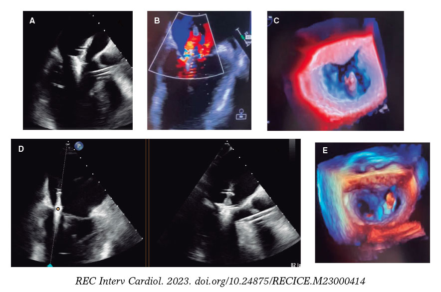 Impella Supported Mitraclip Implantation In Acute Mitral Regurgitation