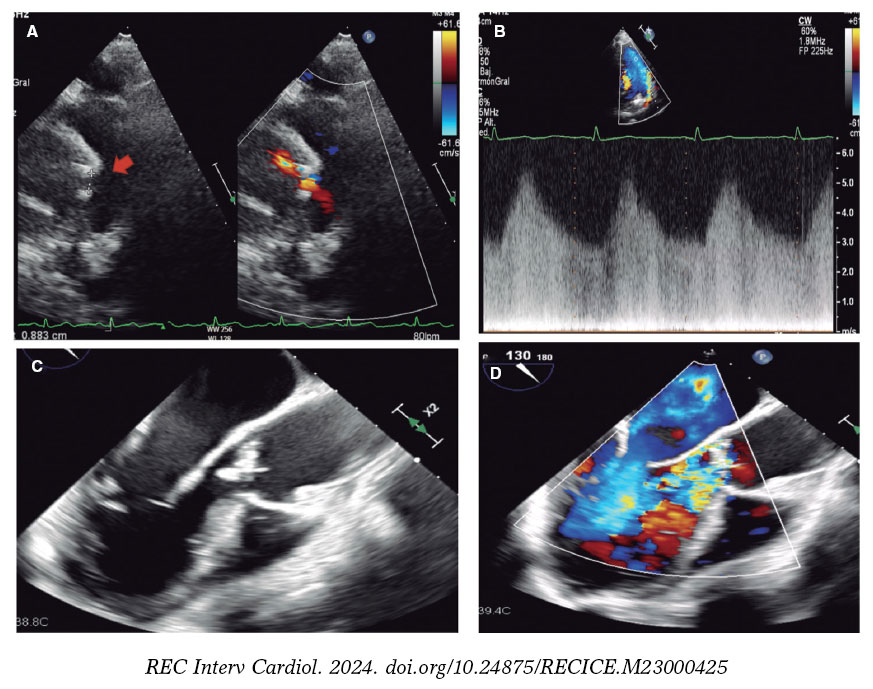 Ductus arteriosus presenting as systemic and pulmonary embolism