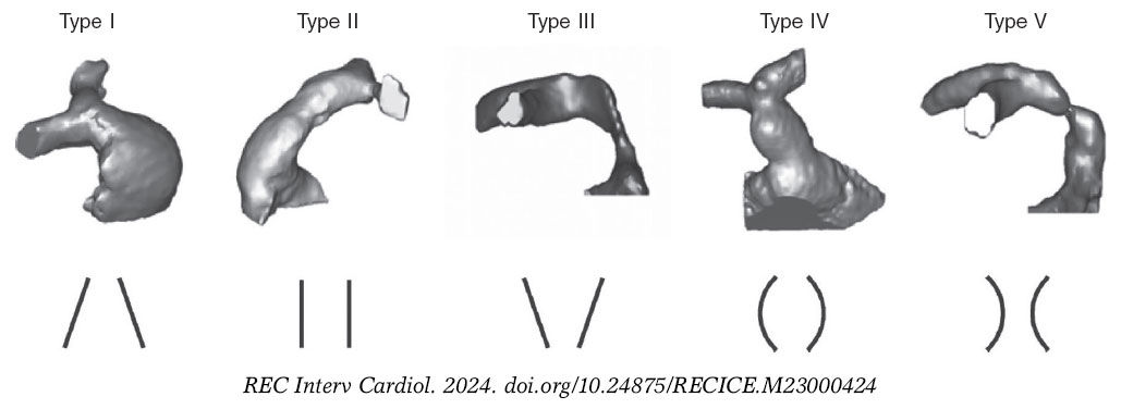 Percutaneous pulmonary valve implantation in native outflow tracts: has ...