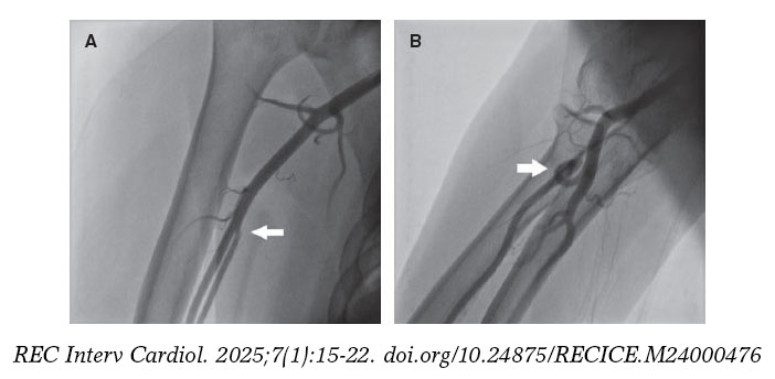 Incidence and predictors of radial artery occlusion following ...