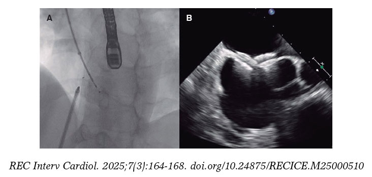 Patch Closure Transcatheter closure of multiperforated atrial septal defect