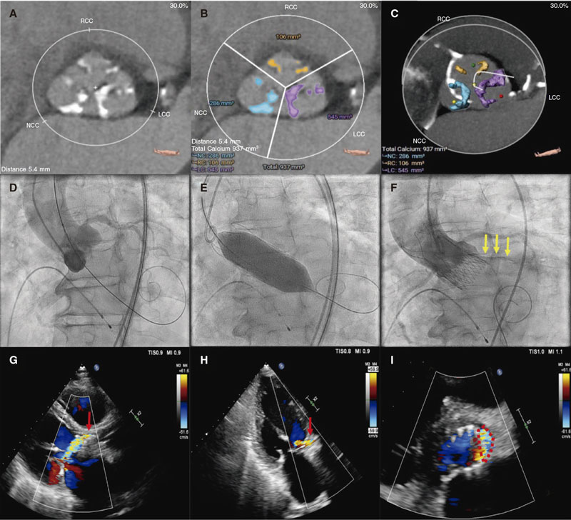 Paravalvular leak with ACURATE neo and neo2: a comparative study with ...