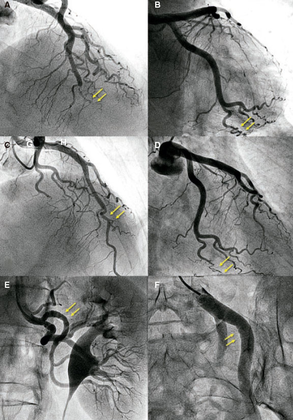 Contemporary management of spontaneous coronary dissection