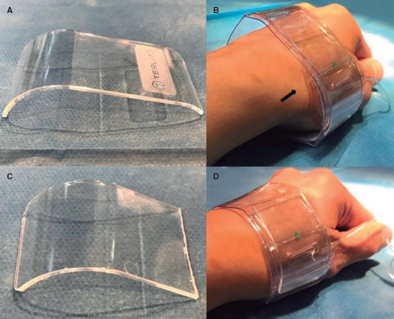 TR Band modification for distal transradial access hemostasis