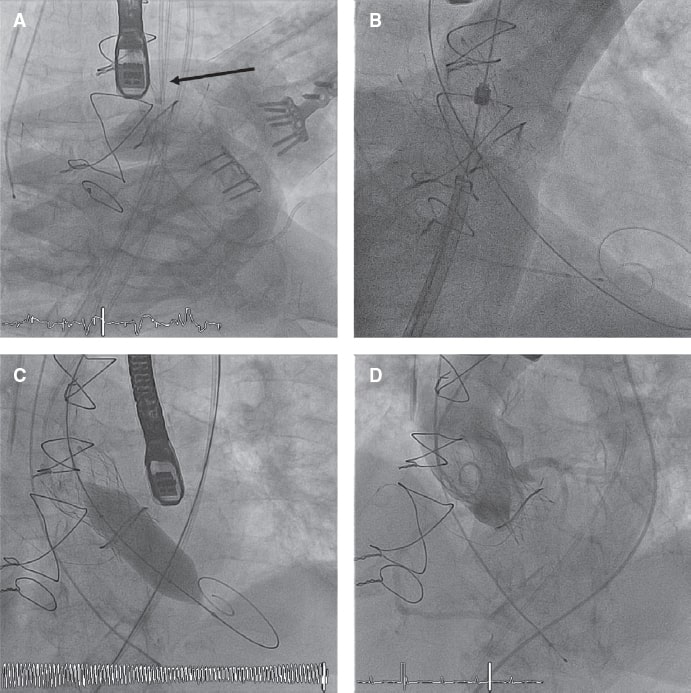 Prevention of coronary occlusions during transcatheter aortic valve-in ...