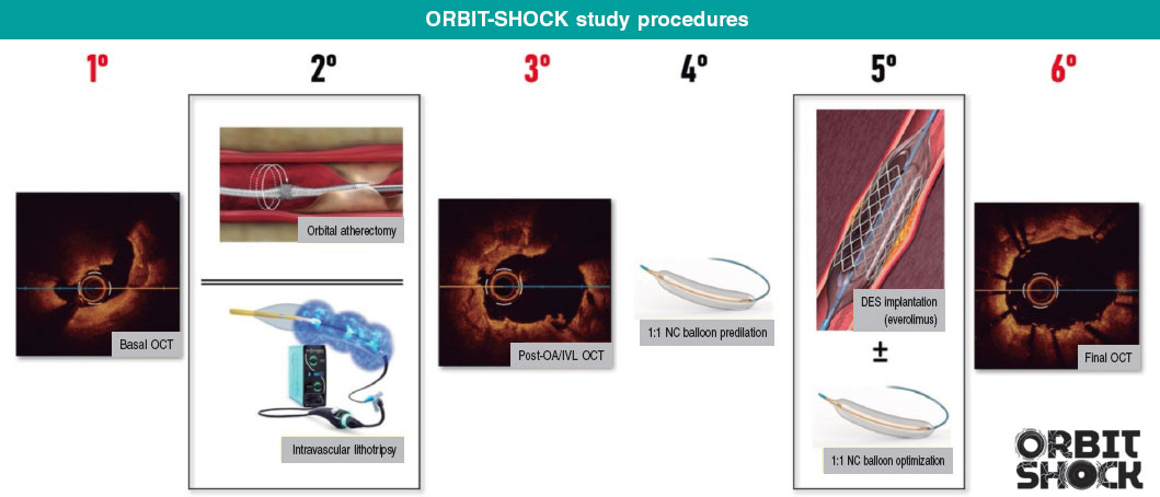 Design of the ORBIT-SHOCK pilot study: orbital atherectomy vs ...